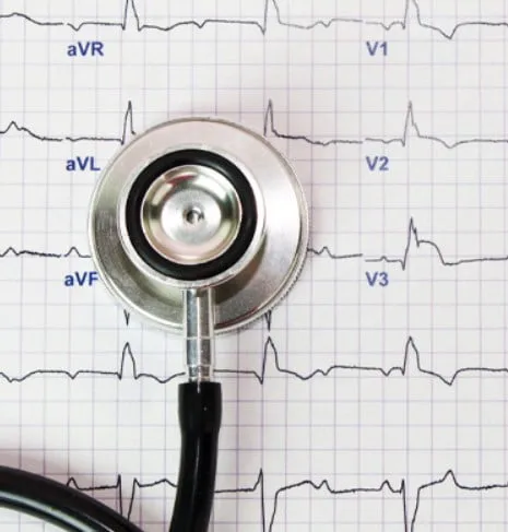 EKG electrocardiograms