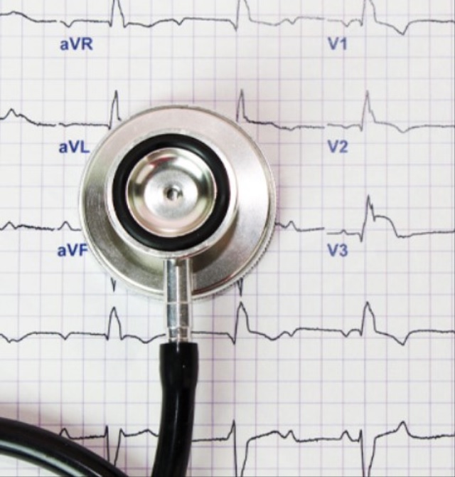 Demystifying EKGs: Understanding the Science, Applications, and Importance of Electrocardiograms